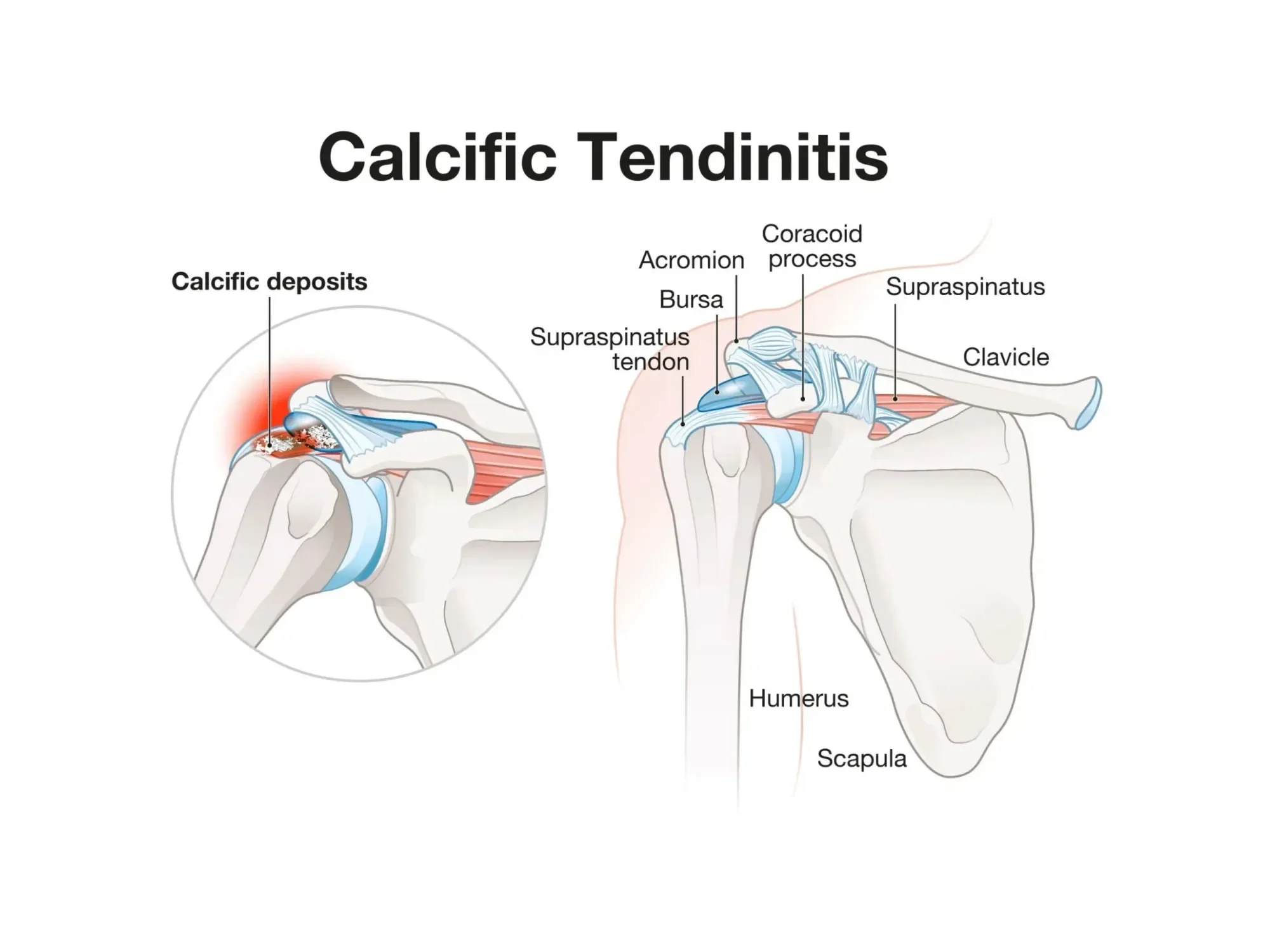 Calcific Tendonitis